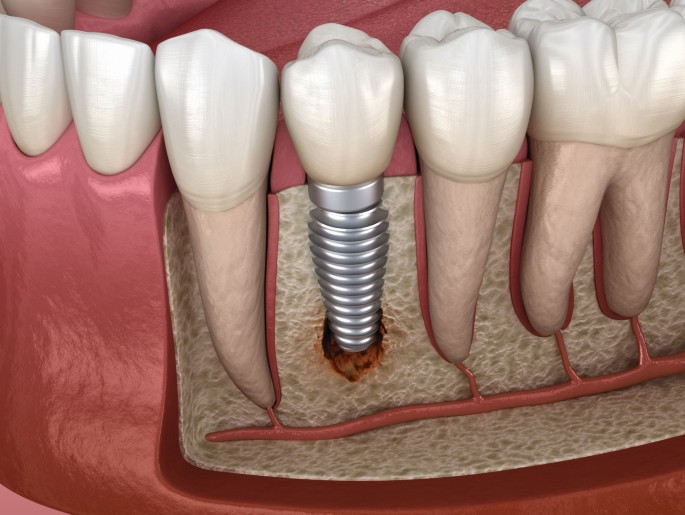 Why Dental Implants Are The Perfect Solution For Missing Teeth