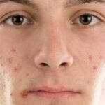 Acne Treatment and Makeup: Safe Application Tips)