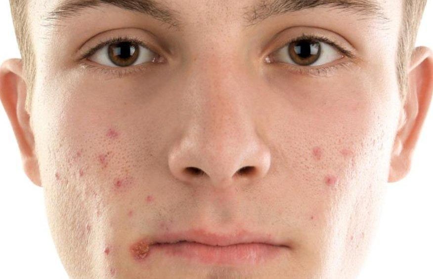 Acne Treatment and Makeup: Safe Application Tips)