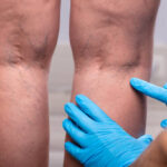 Trusted Vascular Surgeon Near You in Fremont, CA — West Coast Veins & Vascular