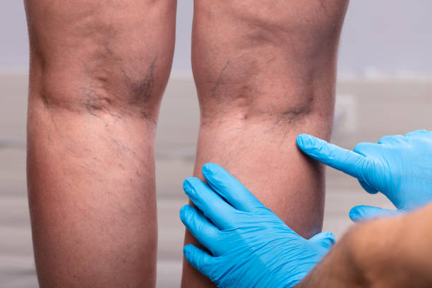 Trusted Vascular Surgeon Near You in Fremont, CA — West Coast Veins & Vascular