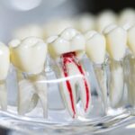Root Canal Treatment for Kids: Is It Safe?