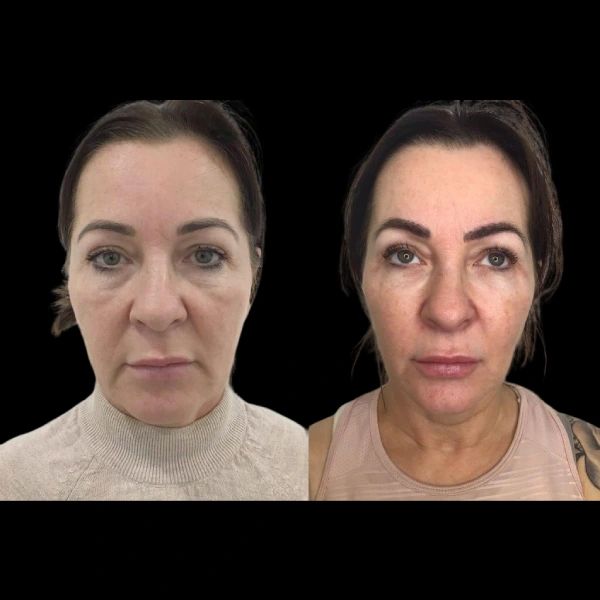 Profhilo Treatment Trends by Best Plastic Surgeon in Dubai