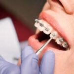 Complete Guide to Dental Braces Treatment in Bilaspur for First-Time Patients