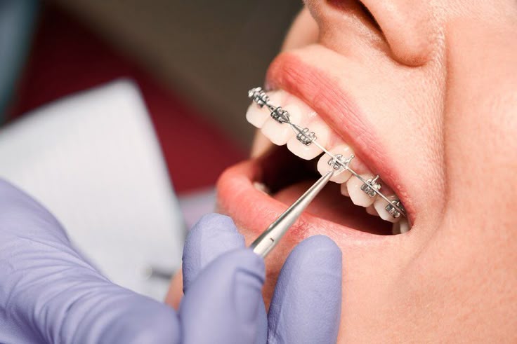Complete Guide to Dental Braces Treatment in Bilaspur for First-Time Patients