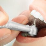 Why Teeth Cleaning Is Important for Healthy Teeth & Gums