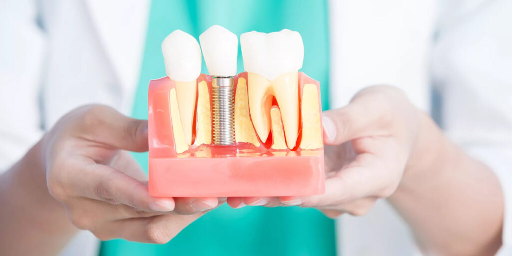 Get Your Smile Back Forever with Dental Implants in Hiranandani Estate