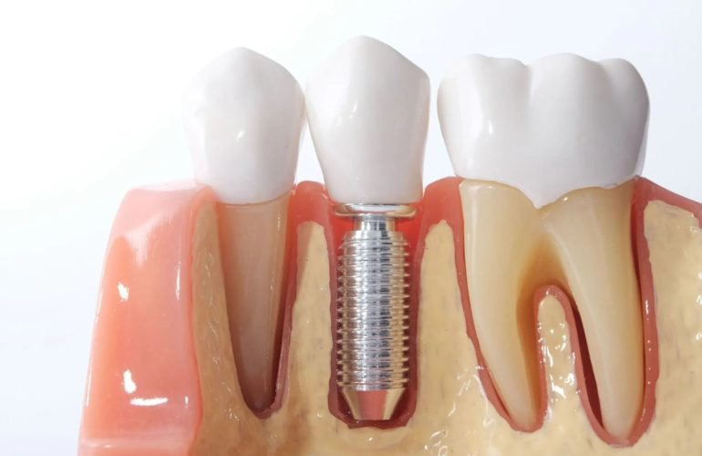 Dental Implant Treatment: Safe and Effective Tooth Replacement
