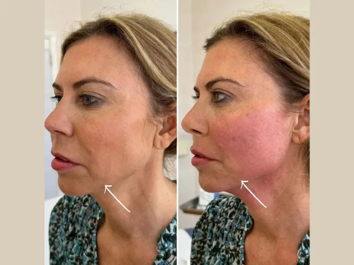 Endolift Treatments in Dubai for Natural Beauty Enhancement