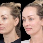 How Cheek Fillers Treatments in Dubai Help You Look Younger and Fresher