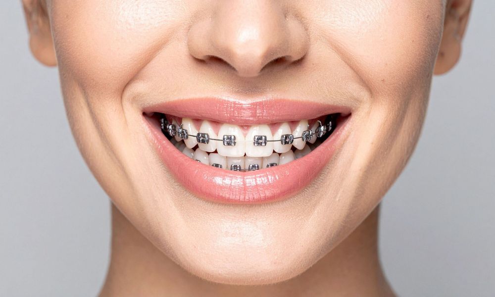 Pain-Free Braces Treatment: Is It Really Possible?