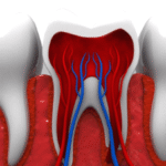 Best Root Canal Treatment in Bistupur Pain Relief Guide You Need
