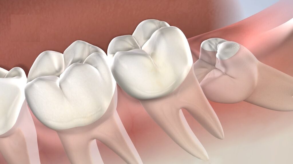 Understanding Wisdom Tooth Removal Cost in Wanowrie: A Complete Guide