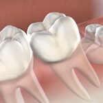 Understanding Wisdom Tooth Removal Cost in Wanowrie: A Complete Guide