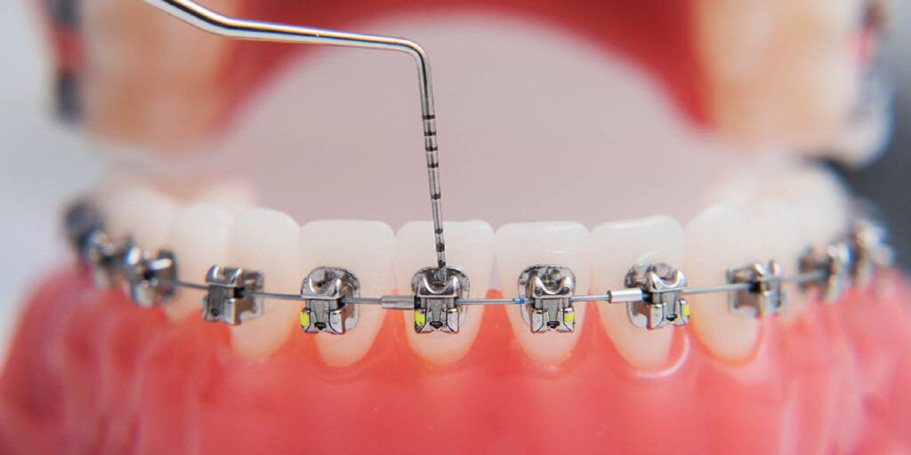 Is Braces Treatment Worth It Real Results and Benefits