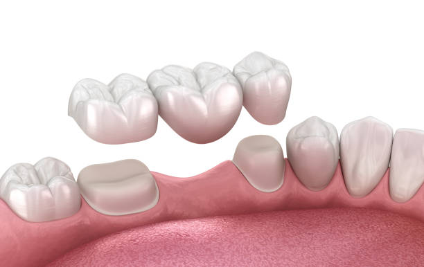 How Much Do Dental Crowns and Bridges Cost in Seawoods? Complete Guide