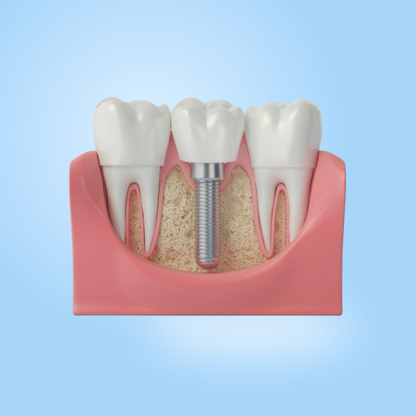 What is the Cost of a Dental Implant in Hadapsar?