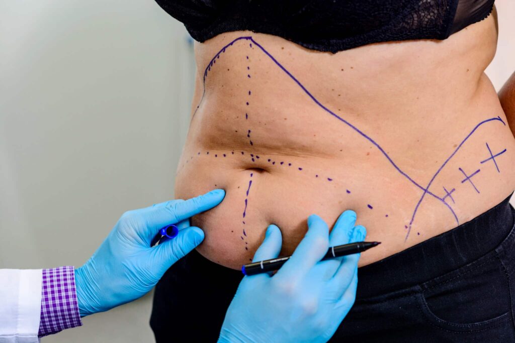 Mommy Makeover for Restoring Confidence and Post-Pregnancy Body Contours