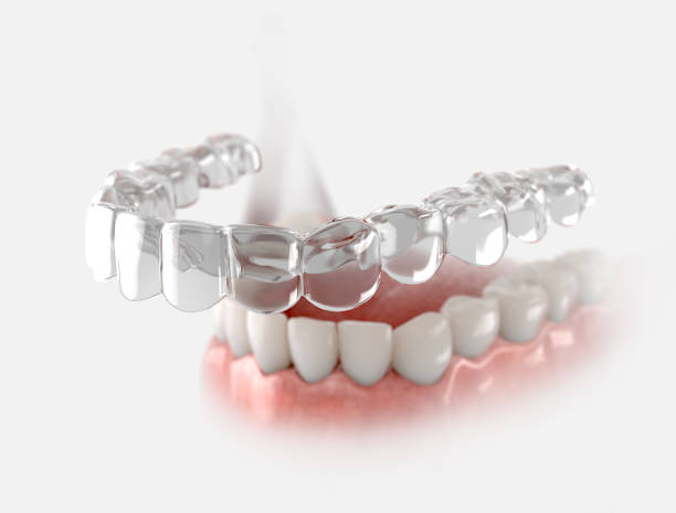 Mumbai Invisible Aligners: Use Opal Dental’s State-of-the-Art Clear Aligners to Get the Ideal Smile