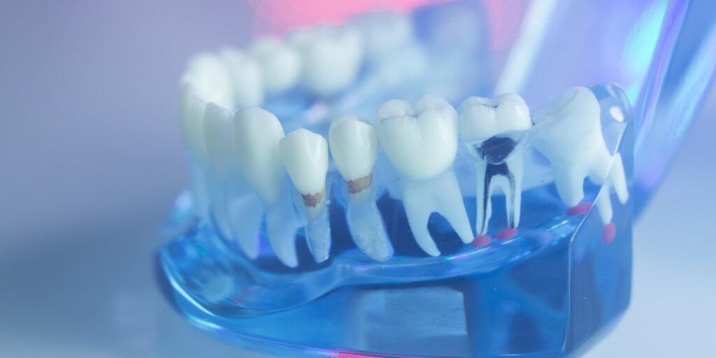A Complete Guide to Choosing the Best Dentist for Your Root Canal