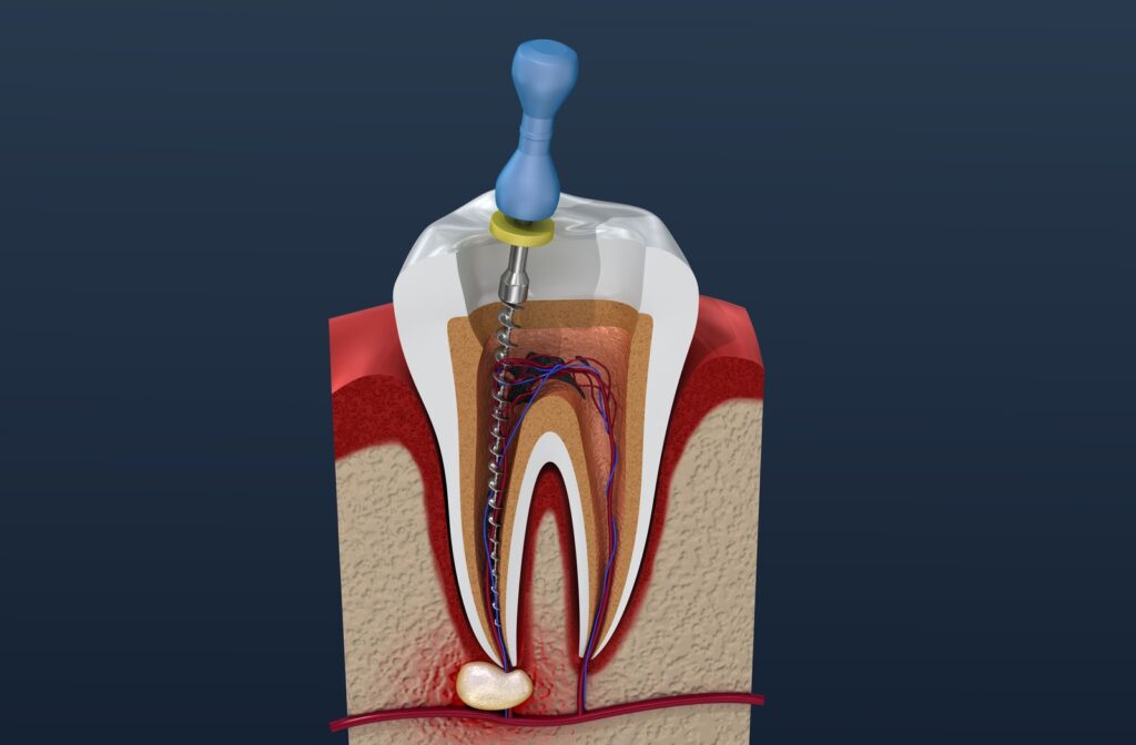 Root Canal Treatment: Step-by-Step Journey to Recovery