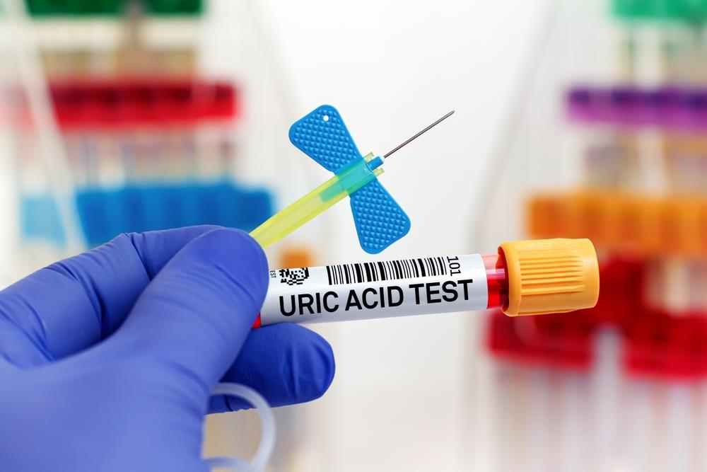 What Causes High Uric Acid Levels? Insights from Your Test