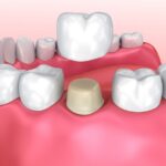 Dental Crown Dubai Procedure: Step-by-Step Guide