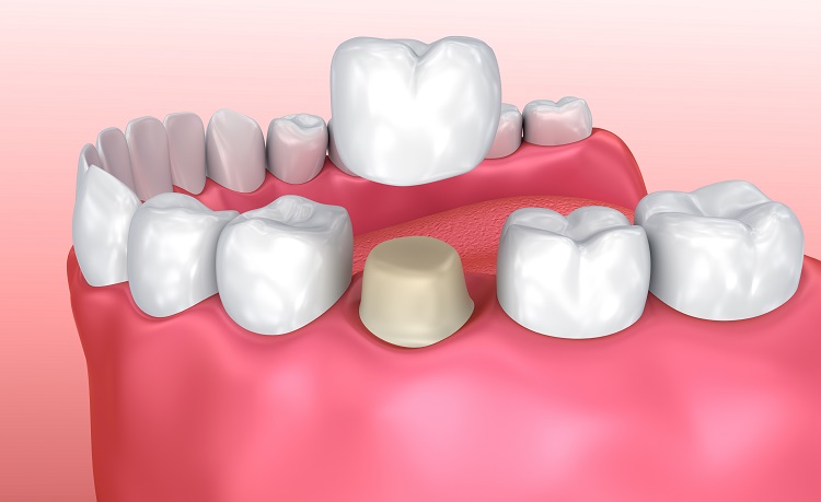 Dental Crown Dubai Procedure: Step-by-Step Guide
