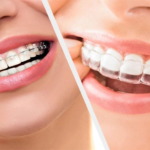 Clear Aligners vs Metal Braces: A Complete Guide to Choosing the Right Treatment