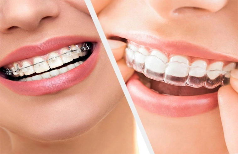 Clear Aligners vs Metal Braces: A Complete Guide to Choosing the Right Treatment