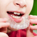 Mouth Guard for Kids in Sports Protect Teeth the Right Way