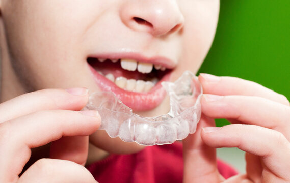 Mouth Guard for Kids in Sports Protect Teeth the Right Way