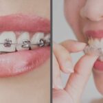 Braces Treatment vs Invisalign Which Option Is Better