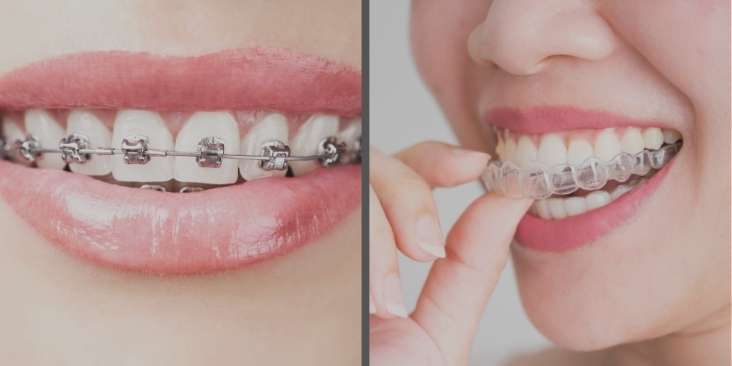 Braces Treatment vs Invisalign Which Option Is Better