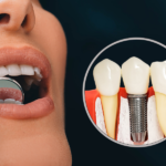 Is Dental Implant Treatment Painful? What to Expect