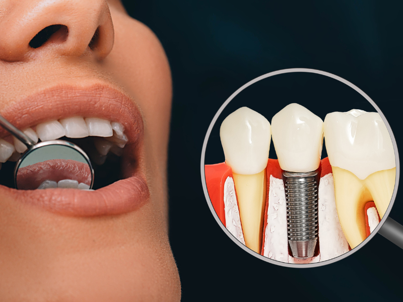 Is Dental Implant Treatment Painful? What to Expect
