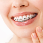 Complete Guide to Braces Treatment: Types, Cost, and Results