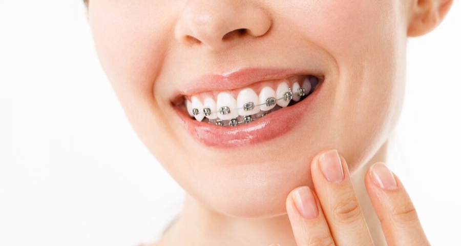 Complete Guide to Braces Treatment: Types, Cost, and Results