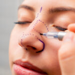 Alarplasty Explained: A Beginner’s Complete Guide