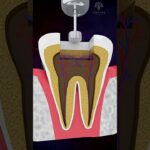 Root Canal Treatment Cost for Front and Back Teeth Guide