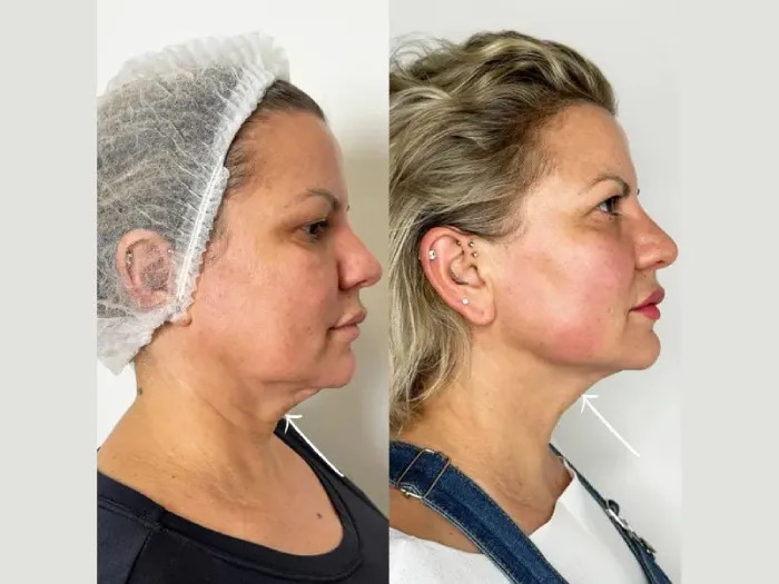 Best Plastic Surgeon in dubai for Neck Tightening with Endolift