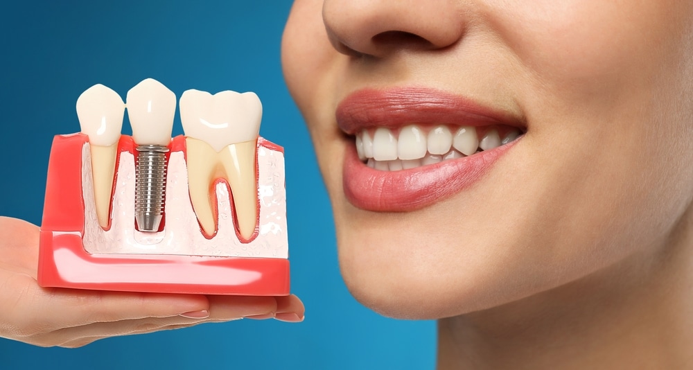 Affordable Dental Implant for Missing Teeth Best Solution