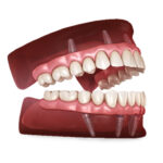 Complete Guide to Overdentures for Missing Teeth