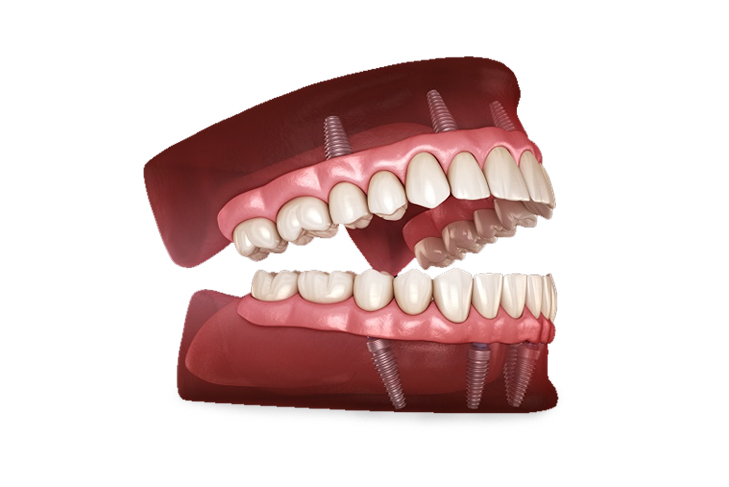 Complete Guide to Overdentures for Missing Teeth