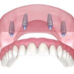 Transform Your Smile with Advanced Dental Implant Care