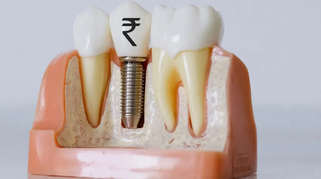 Understanding Dental Implant Costs: 7 Factors That Impact Your Treatment Price