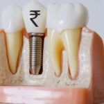 Understanding Dental Implant Costs: 7 Factors That Impact Your Treatment Price