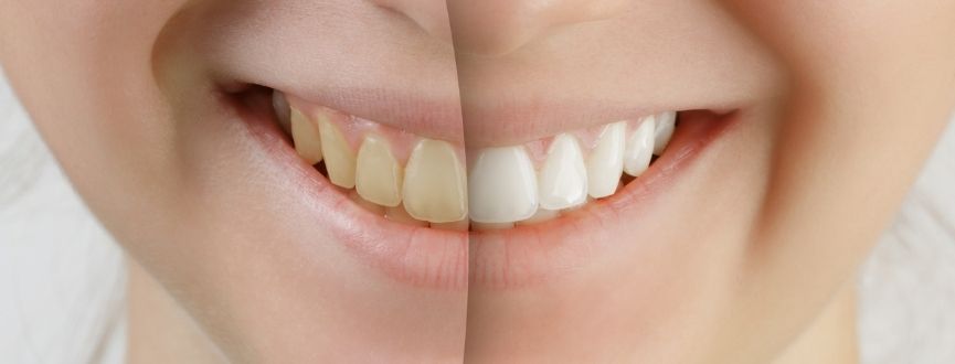 Teeth Whitening in 2026: Safe, Instant and Long-Lasting Smile Brightening Solutions