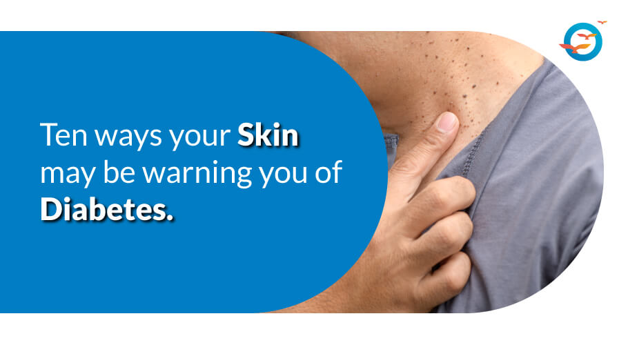 10 Ways Your Skin May Be Warning You of Diabetes