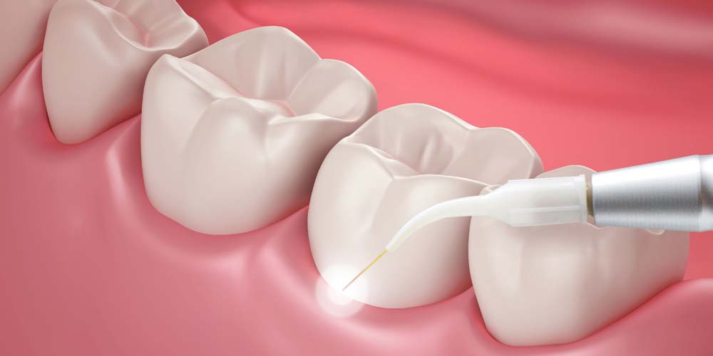 How to Treat Gum Disease Early and Protect Your Smile